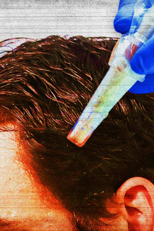 Mikroiğneleme Nedir ve Gerçekten Saç Dökülmesini Önler mi?