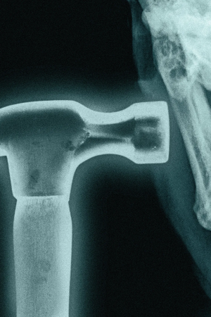 Bonesmashing Nedir? Dış Görünüş Takıntısının En Uç Noktasındaki Tehlikeli Trend