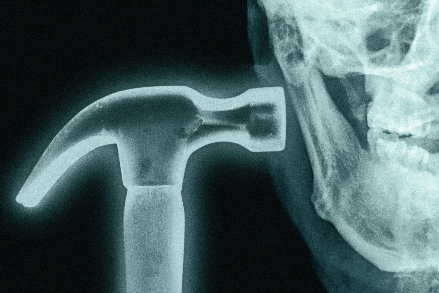 Bonesmashing Nedir? Dış Görünüş Takıntısının En Uç Noktasındaki Tehlikeli Trend