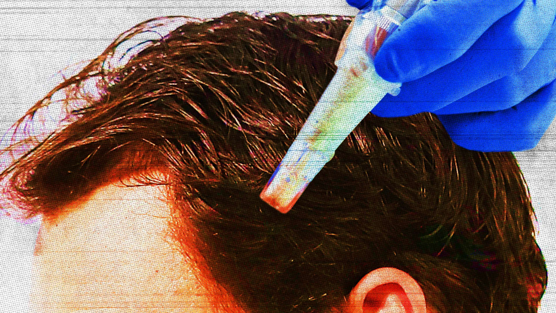 Mikroiğneleme Nedir ve Gerçekten Saç Dökülmesini Önler mi?