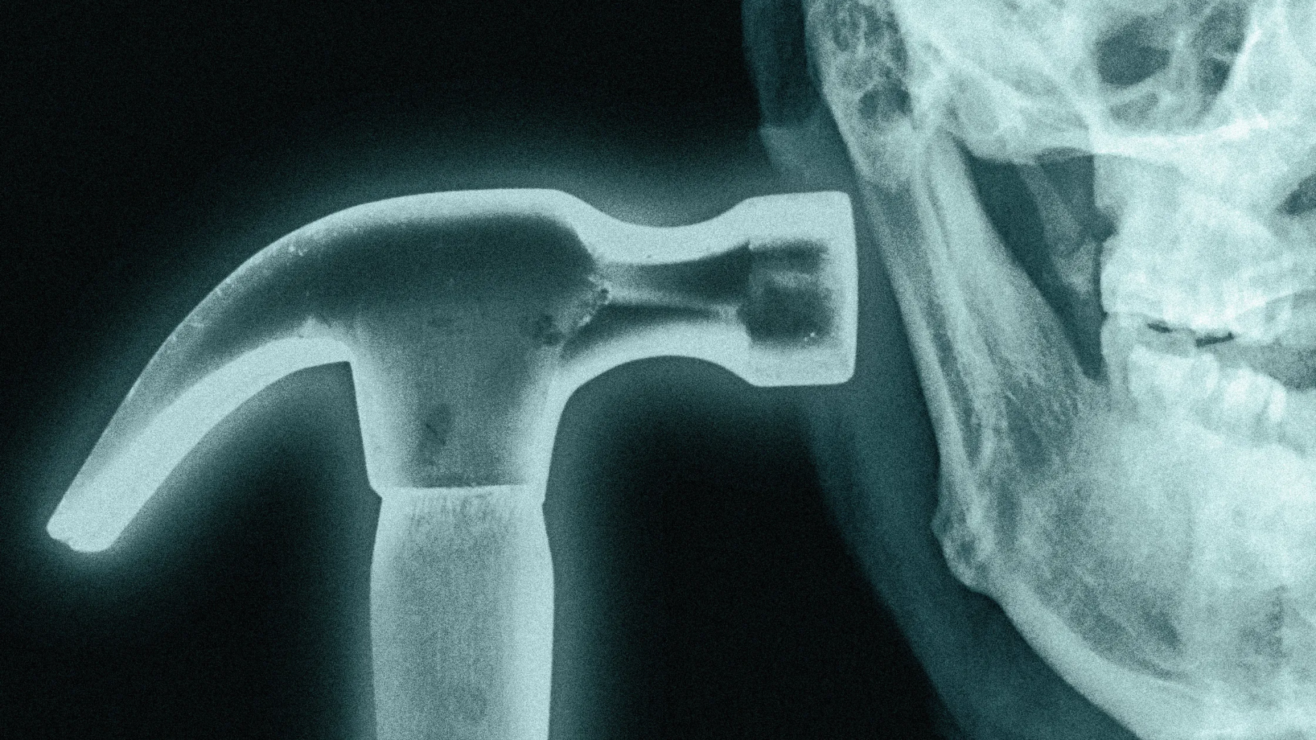 Bonesmashing Nedir? Dış Görünüş Takıntısının En Uç Noktasındaki Tehlikeli Trend